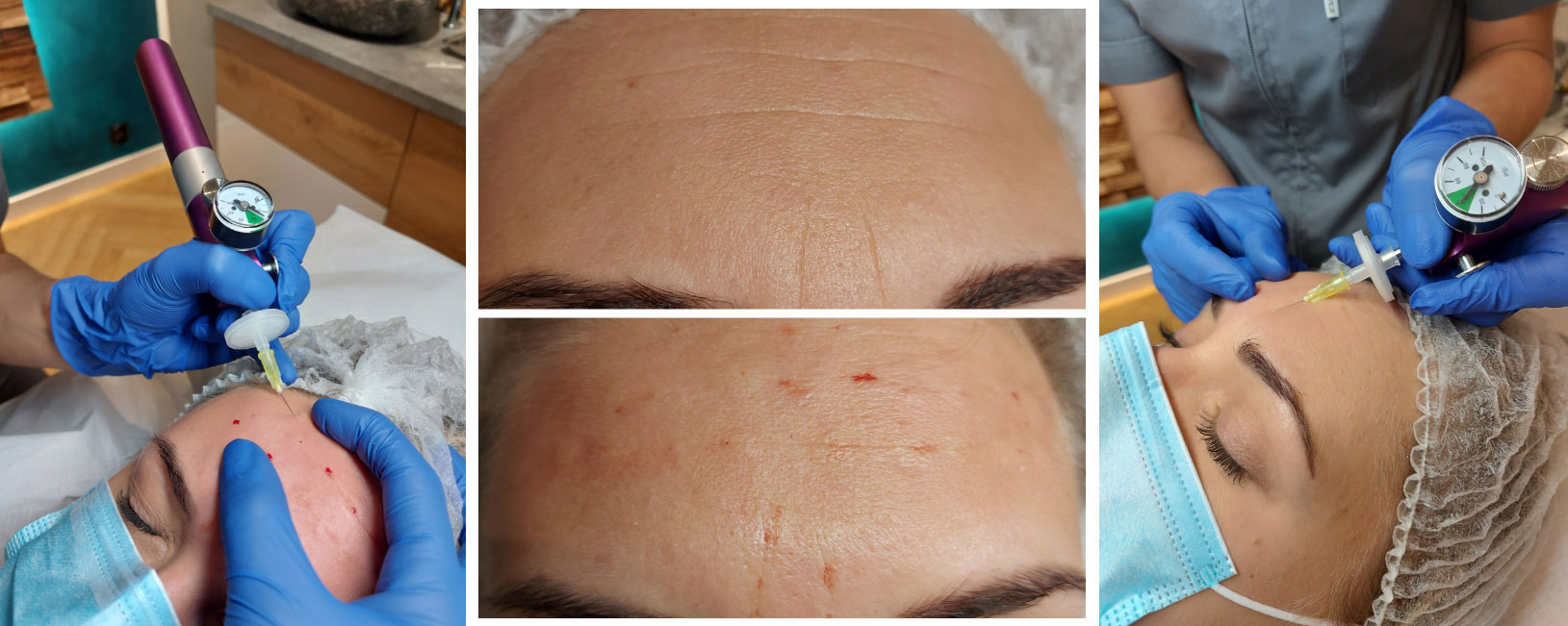 Karboksyterapia Torun Makijaz permanentny Hebe Day Spa Karboksyterapia